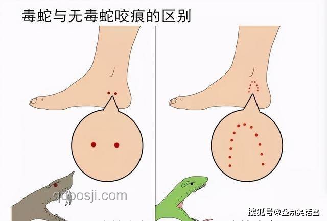 三亚被咬女子案：了解神经毒蛇咬伤知识